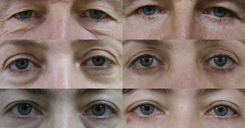 удаление мешков: до и после