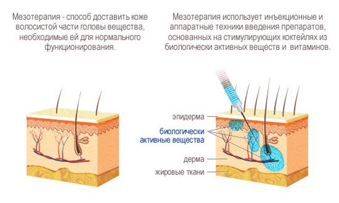 Инъекционные методы лечения выпадения волос