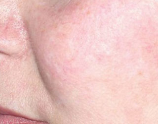 Удаление и лечение купероза на лице до и после